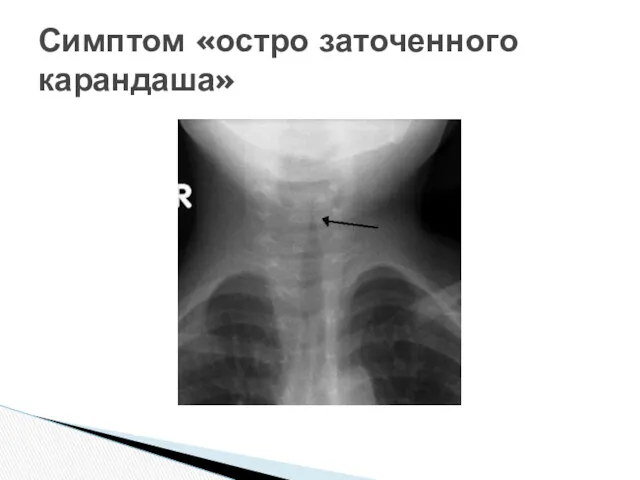 Симптом «остро заточенного карандаша»