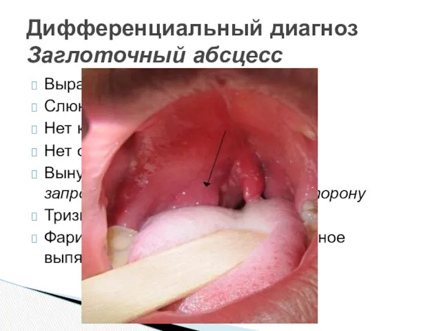 Выраженная интоксикация Слюнотечение Нет кашля Нет охриплости Вынужденное положение :