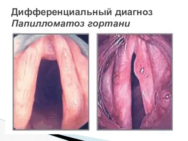 Постепенное развитие Усиление охриплости афония Признаки стеноза гортани асфиксия Диагностика