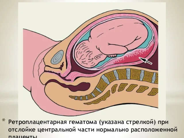 Ретроплацентарная гематома (указана стрелкой) при отслойке центральной части нормально расположенной плаценты.
