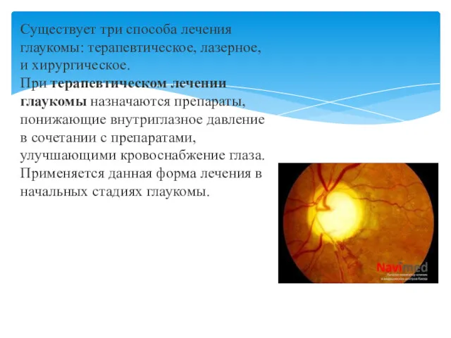 Существует три способа лечения глаукомы: терапевтическое, лазерное, и хирургическое. При терапевтическом лечении глаукомы