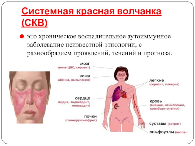 Системная красная волчанка (СКВ) это хроническое воспалительное аутоиммунное заболевание неизвестной