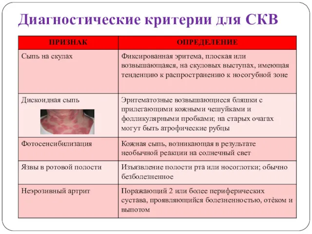 Диагностические критерии для СКВ