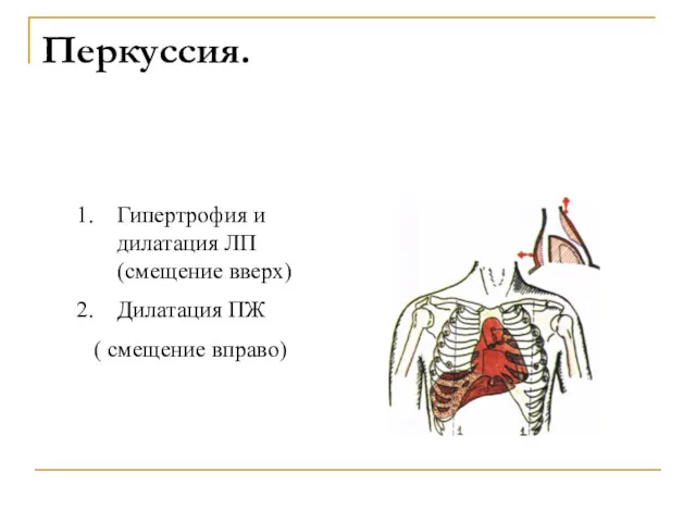 Перкуссия. Гипертрофия и дилатация ЛП (смещение вверх) Дилатация ПЖ ( смещение вправо)