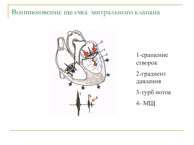 Возникновение щелчка митрального клапана 1-сращение створок 2-градиент давления 3-турб поток 4- МЩ