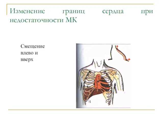 Изменение границ сердца при недостаточности МК Смещение влево и вверх