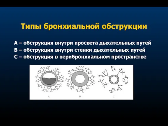 Типы бронхиальной обструкции А – обструкция внутри просвета дыхательных путей