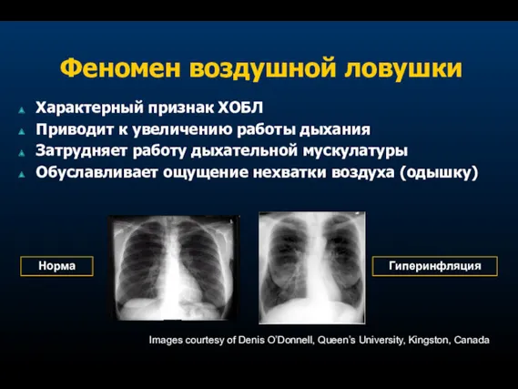 Феномен воздушной ловушки Характерный признак ХОБЛ Приводит к увеличению работы