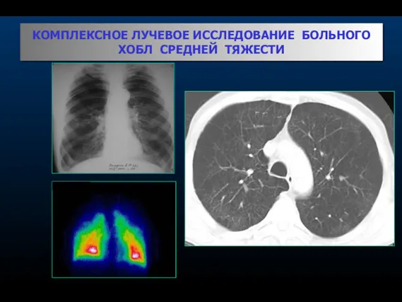 КОМПЛЕКСНОЕ ЛУЧЕВОЕ ИССЛЕДОВАНИЕ БОЛЬНОГО ХОБЛ СРЕДНЕЙ ТЯЖЕСТИ