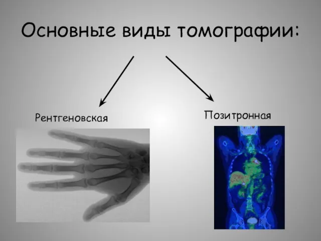 Основные виды томографии: Рентгеновская Позитронная