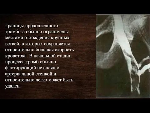 Границы продолженного тромбоза обычно ограничены местами отхождения крупных ветвей, в