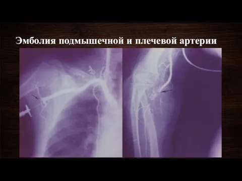 Эмболия подмышечной и плечевой артерии