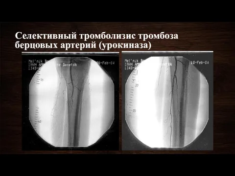 Селективный тромболизис тромбоза берцовых артерий (урокиназа)