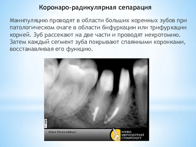 Коронаро-радикулярная сепарация Манипуляцию проводят в области больших коренных зубов при