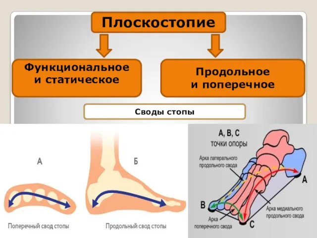 Плоскостопие Функциональное и статическое Продольное и поперечное Своды стопы