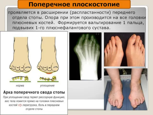 проявляется в расширении (распластанности) переднего отдела стопы. Опора при этом