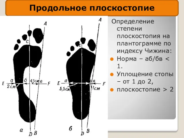 Определение степени плоскостопия на плантограмме по индексу Чижина: Норма –