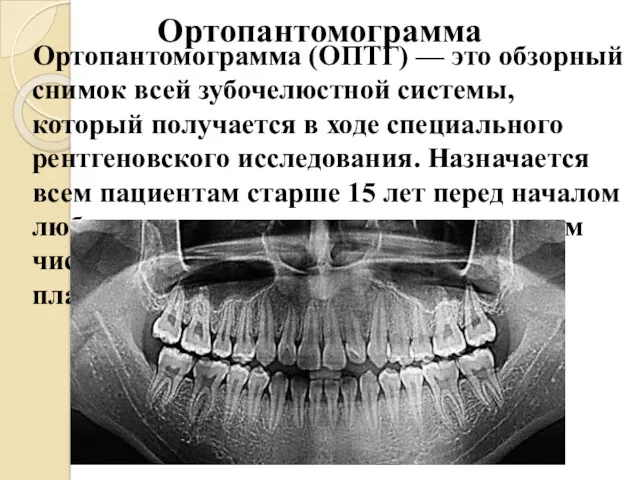 Ортопантомограмма Ортопантомограмма (ОПТГ) — это обзорный снимок всей зубочелюстной системы,