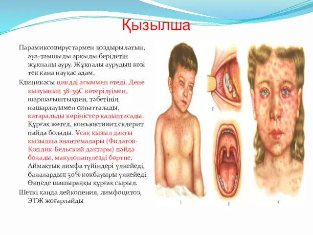 Қызылша Парамиксовирустармен қоздырылатын, ауа-тамшылы арқылы берілетін жұқпалы ауру. Жұқпалы аурудың