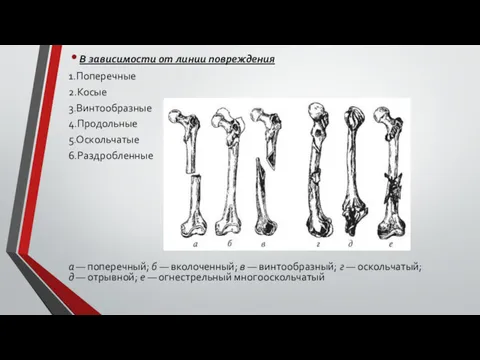 В зависимости от линии повреждения 1.Поперечные 2.Косые 3.Винтообразные 4.Продольные 5.Оскольчатые