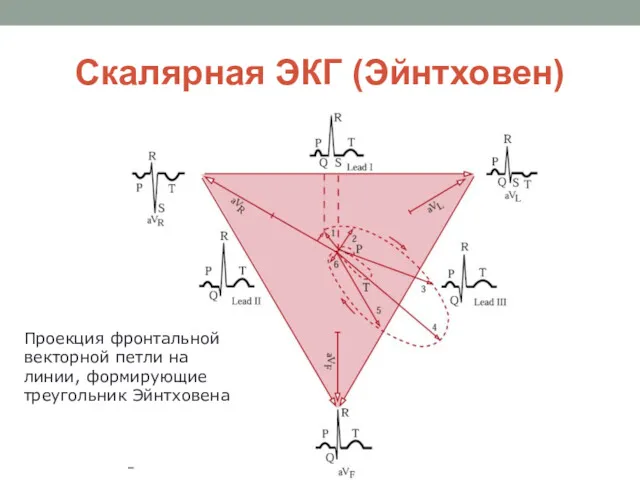 Скалярная ЭКГ (Эйнтховен) Проекция фронтальной векторной петли на линии, формирующие треугольник Эйнтховена