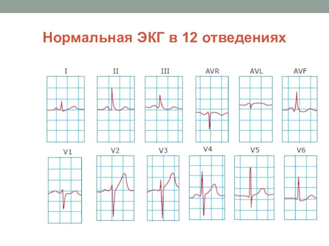 Нормальная ЭКГ в 12 отведениях