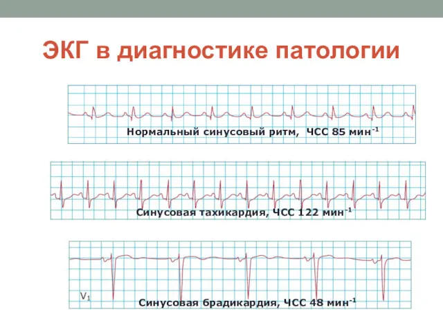 ЭКГ в диагностике патологии Синусовая тахикардия, ЧСС 122 мин-1 Нормальный