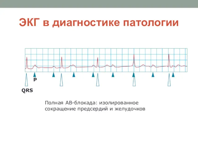 ЭКГ в диагностике патологии Полная АВ-блокада: изолированное сокращение предсердий и желудочков P QRS