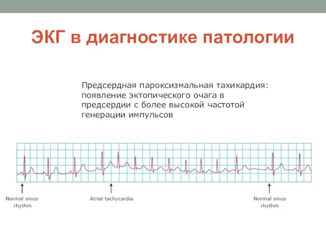 ЭКГ в диагностике патологии Предсердная пароксизмальная тахикардия: появление эктопического очага