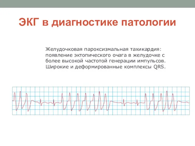 ЭКГ в диагностике патологии Желудочковая пароксизмальная тахикардия: появление эктопического очага