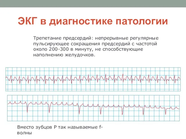 ЭКГ в диагностике патологии Трепетание предсердий: непрерывные регулярные пульсирующее сокращения