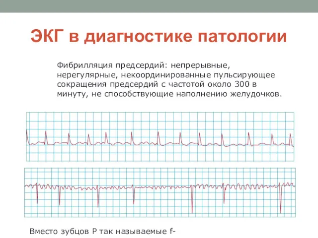 ЭКГ в диагностике патологии Фибрилляция предсердий: непрерывные, нерегулярные, некоординированные пульсирующее