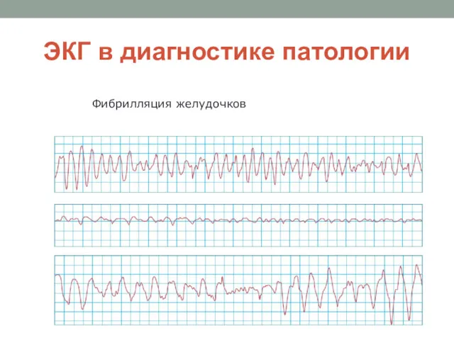 ЭКГ в диагностике патологии Фибрилляция желудочков