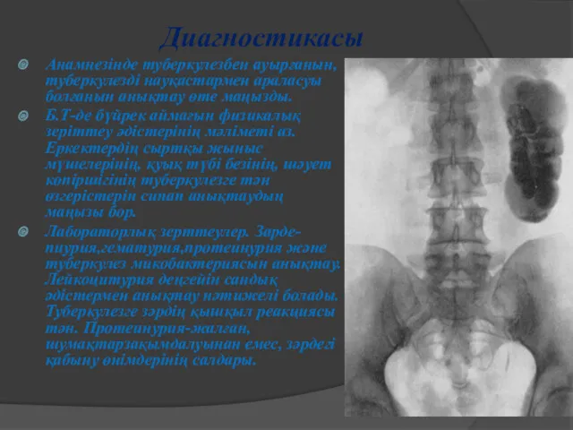 Диагностикасы Анамнезінде туберкулезбен ауырғанын,туберкулезді науқастармен араласуы болғанын анықтау өте маңызды. Б.Т-де бүйрек аймағын