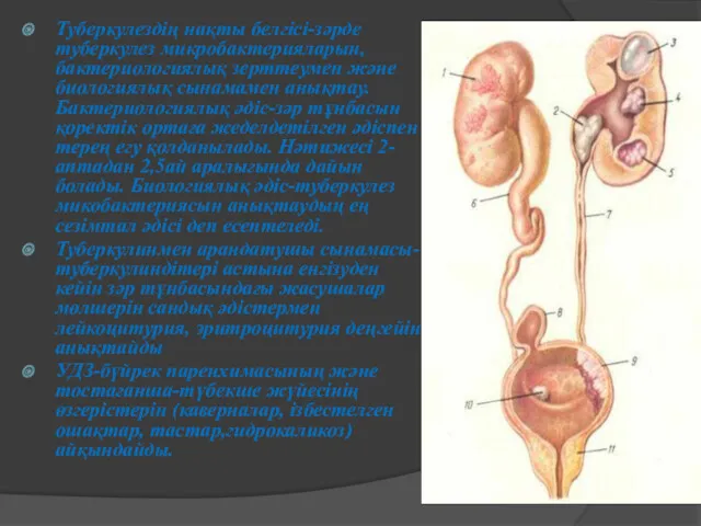 Туберкулездің нақты белгісі-зәрде туберкулез микробактерияларын, бактериологиялық зерттеумен және биологиялық сынамамен