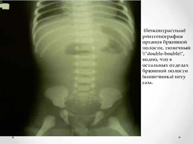 (безконтрастная) рентгенография органов брюшной полости, типичный \\"double-bouble\", видно, что в
