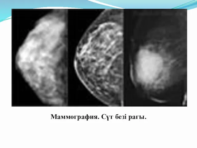 Маммография. Сүт безі рагы.
