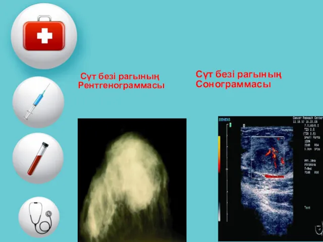 Сүт безі рагының Рентгенограммасы Сүт безі рагының Сонограммасы