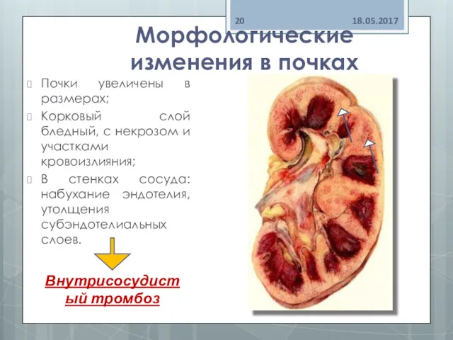 Морфологические изменения в почках Почки увеличены в размерах; Корковый слой