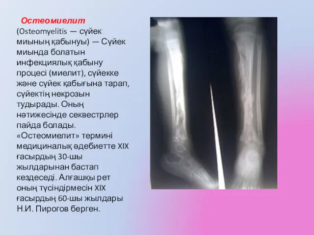 Остеомиелит (Osteomyelitis — сүйек миының қабынуы) — Сүйек миында болатын