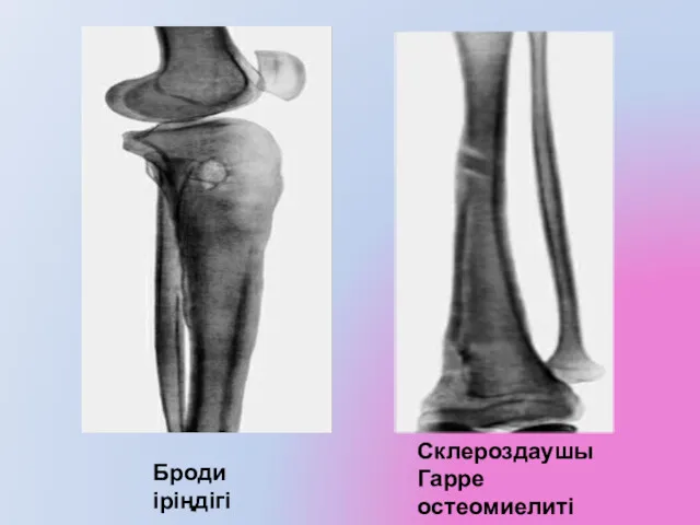 Броди іріңдігі Склероздаушы Гарре остеомиелиті