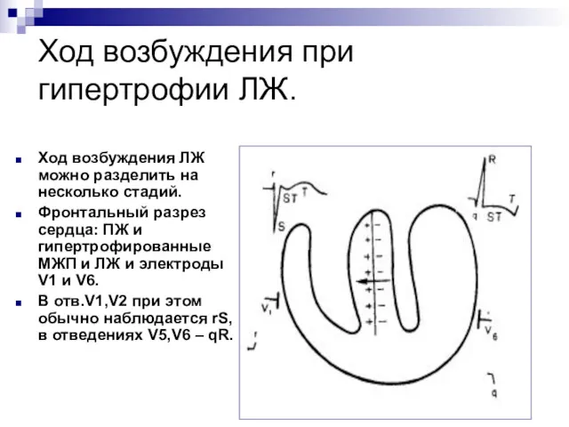 Ход возбуждения при гипертрофии ЛЖ. Ход возбуждения ЛЖ можно разделить