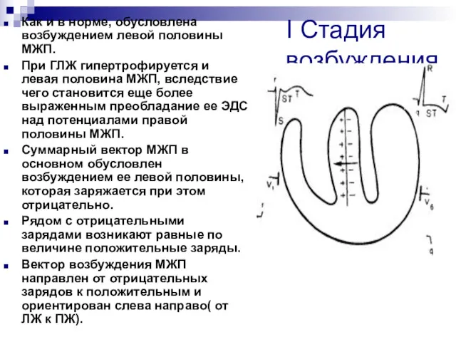 І Стадия возбуждения. Как и в норме, обусловлена возбуждением левой