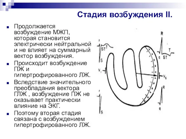 Стадия возбуждения ІІ. Продолжается возбуждение МЖП, которая становится электрически нейтральной