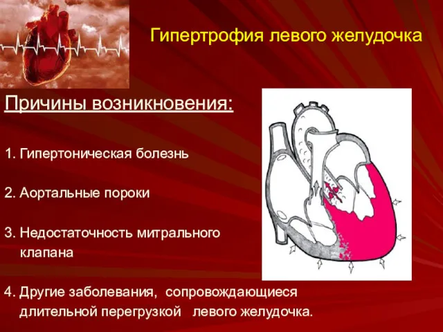 Гипертрофия левого желудочка Причины возникновения: 1. Гипертоническая болезнь 2. Аортальные пороки 3. Недостаточность