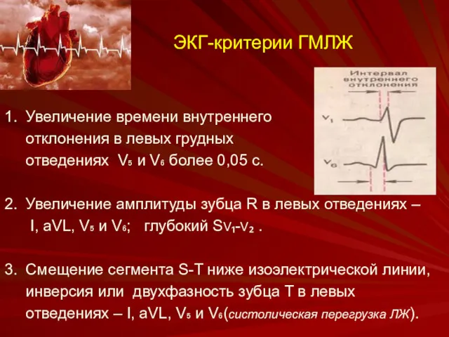 ЭКГ-критерии ГМЛЖ 1. Увеличение времени внутреннего отклонения в левых грудных отведениях V₅ и