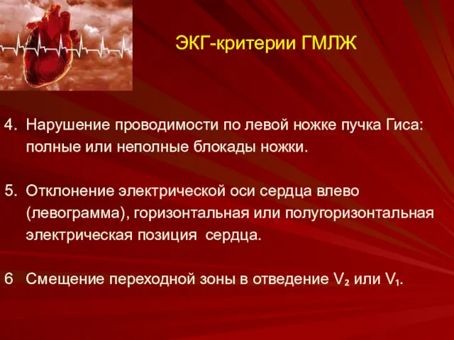 ЭКГ-критерии ГМЛЖ 4. Нарушение проводимости по левой ножке пучка Гиса: полные или неполные