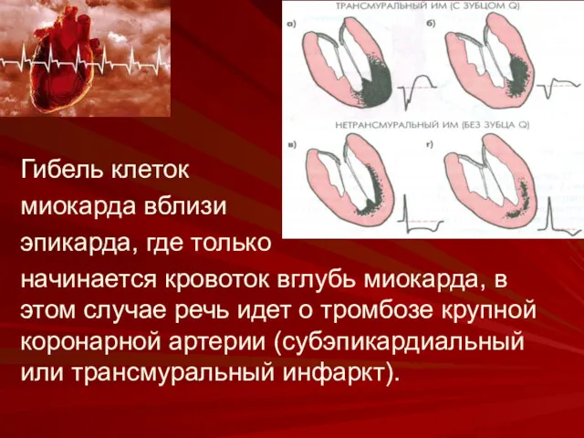 Гибель клеток миокарда вблизи эпикарда, где только начинается кровоток вглубь