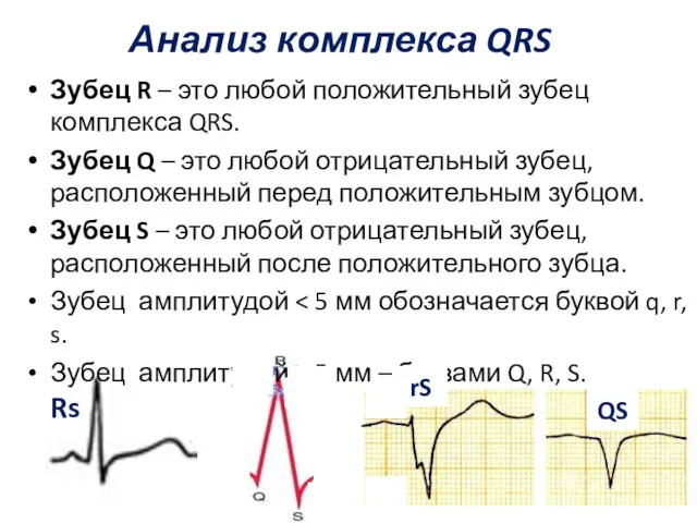 Анализ комплекса QRS Зубец R – это любой положительный зубец