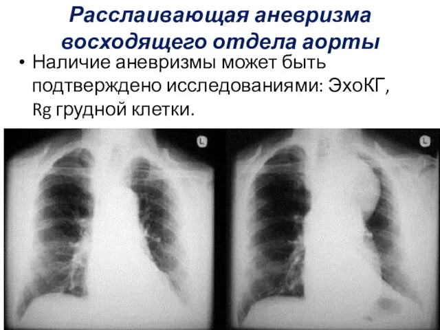 Расслаивающая аневризма восходящего отдела аорты Наличие аневризмы может быть подтверждено исследованиями: ЭхоКГ, Rg грудной клетки.